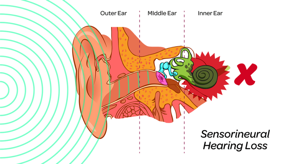 remove ear wax for better hearing